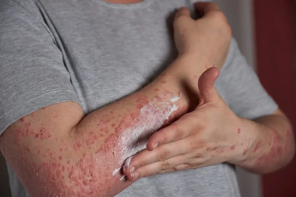 Eczema - Psoriasis Treatment