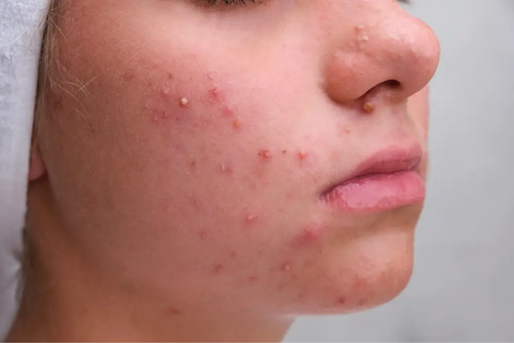 acne treatment