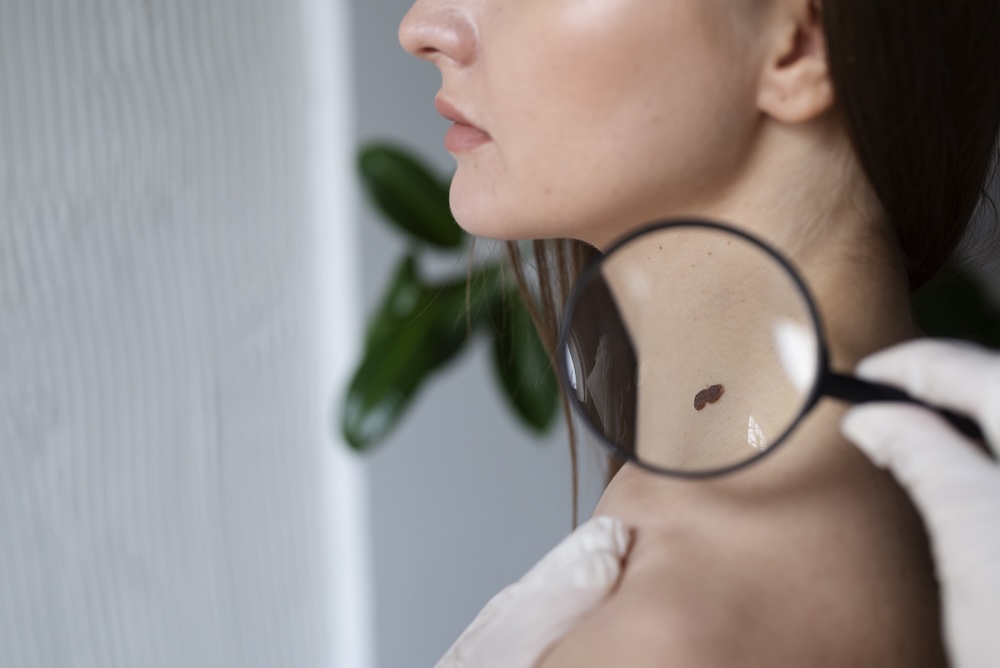 female-doctor-diagnosing-melanoma-body-female-patient