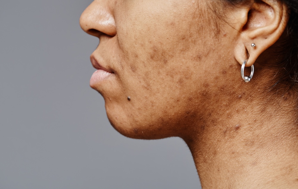 Woman with acne scars on face