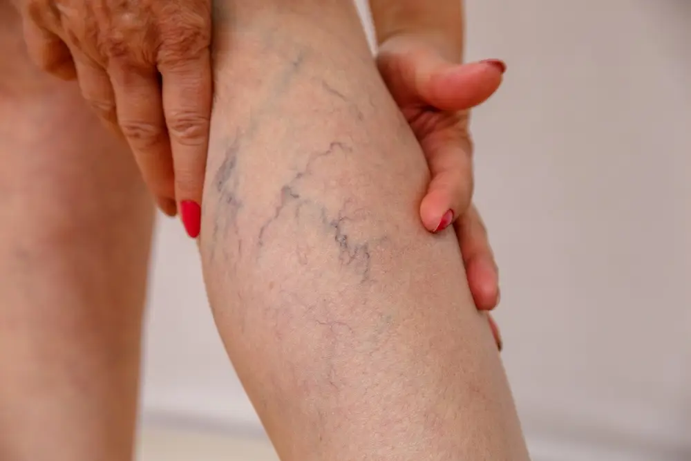 viens treatment